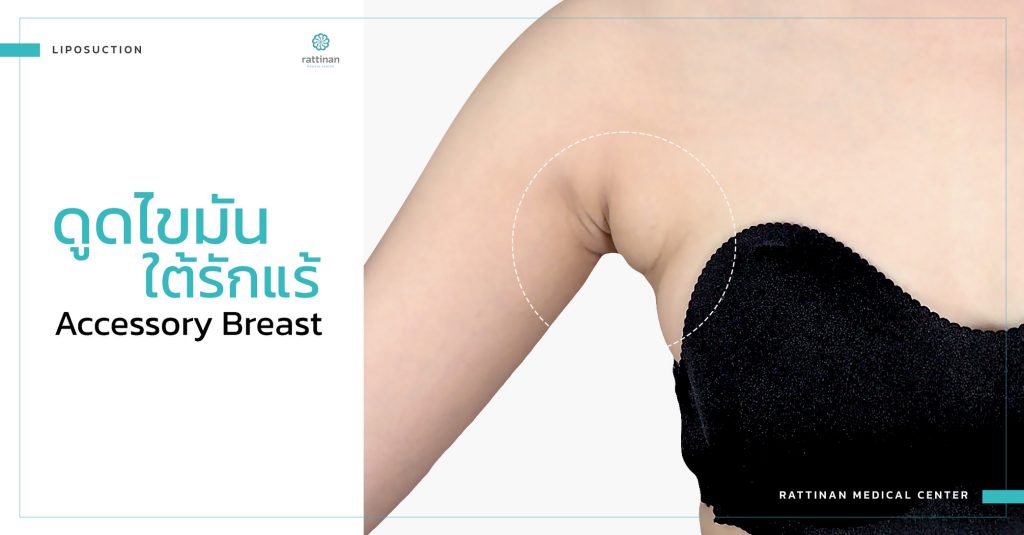 accessory breast liposuction service