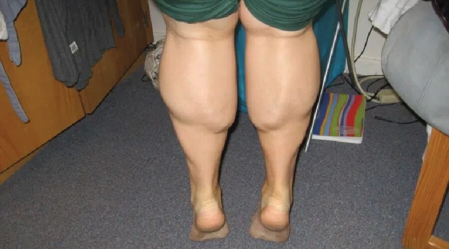 liposuction calf bodytite