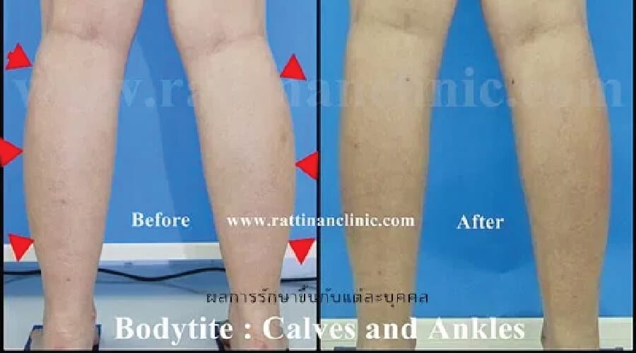 calves liposuction Bodytite by rattinan medical center