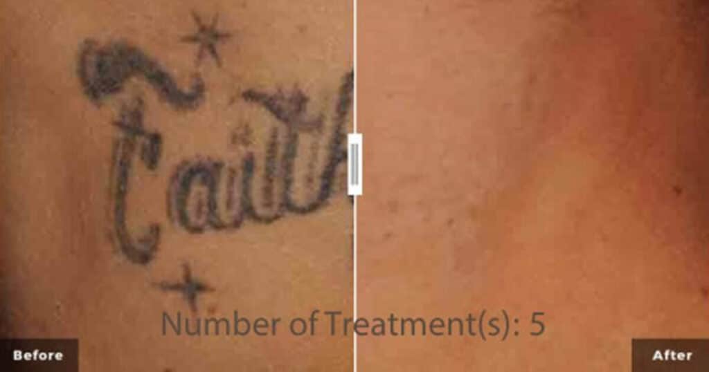 Fonetik kolbe kig ind Laser tattoo removal less pain no redness, tattoo will fade. Without  scarring