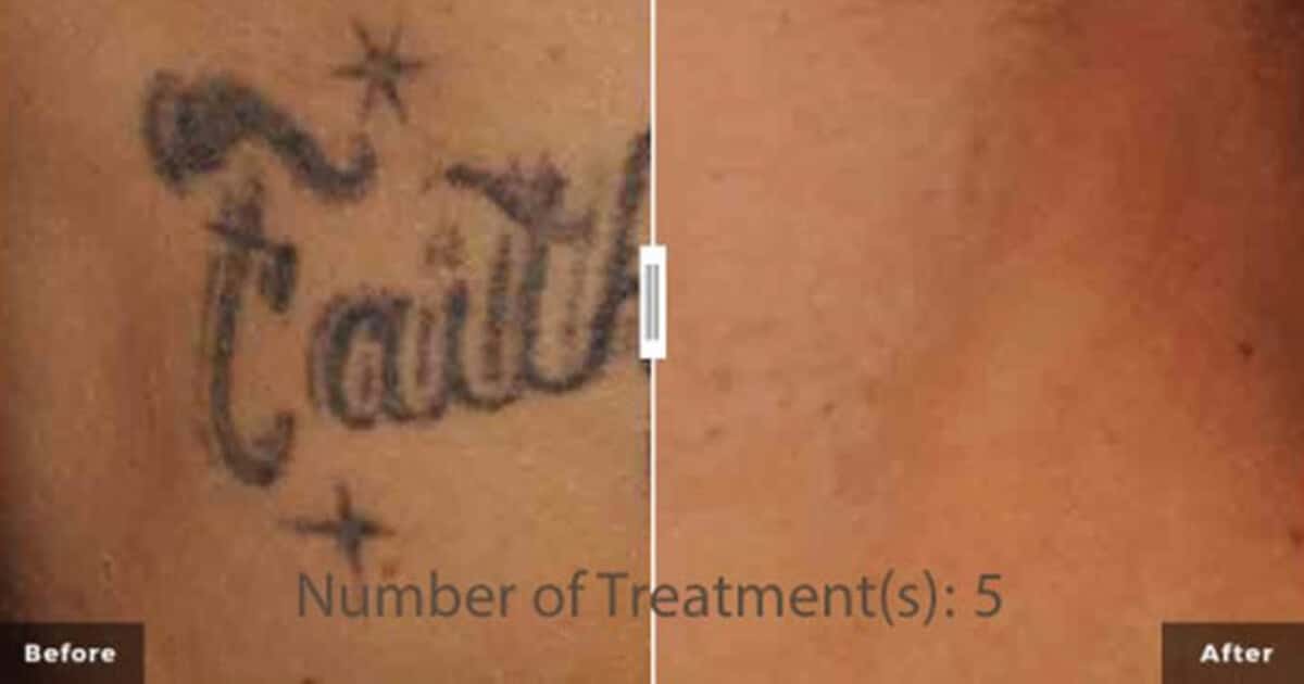 Laser tattoo removal less pain no redness, tattoo will fade. Without  scarring