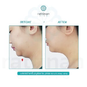 liposuction chin