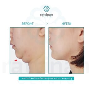 liposuction chin