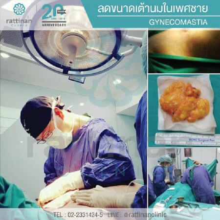 gynecomastia surgery