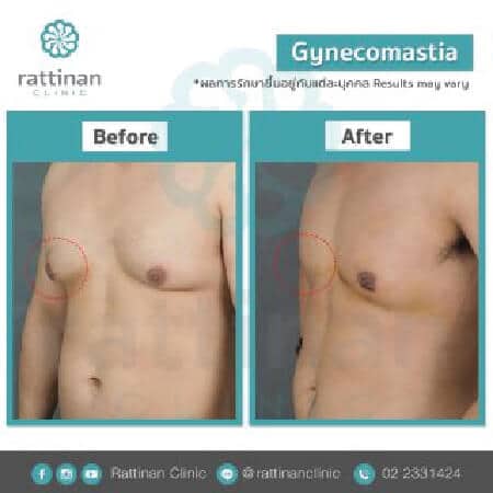 Gynecomastia Surgery in Thailand before and after reviews