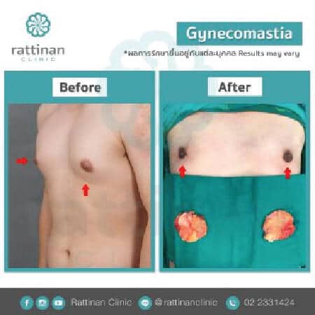 Gynecomastia Surgery in Thailand before and after reviews