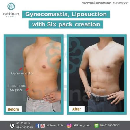 Gynecomastia Surgery in Thailand before and after reviews