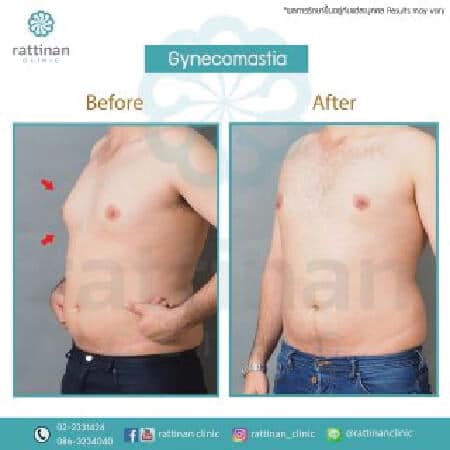 Gynecomastia Surgery in Thailand before and after reviews