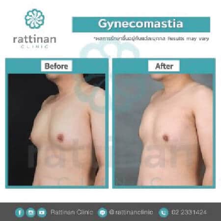 Gynecomastia Surgery in Thailand before and after reviews