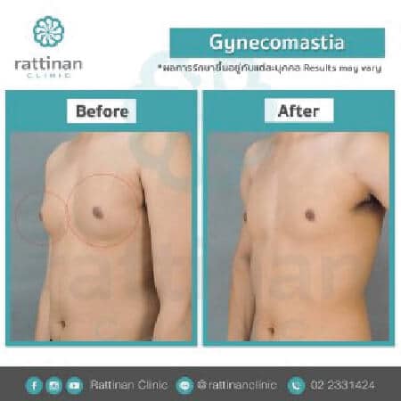 gynecomastia before and after reviews