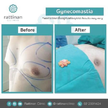 Gynecomastia Surgery in Thailand before and after reviews