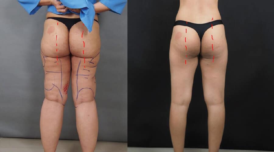 buttock augmentation without scars no pain and inexpensive