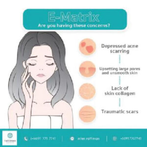 eMatrix: Smooth Skin, Treat Acne Scars—Safe & Affordable!