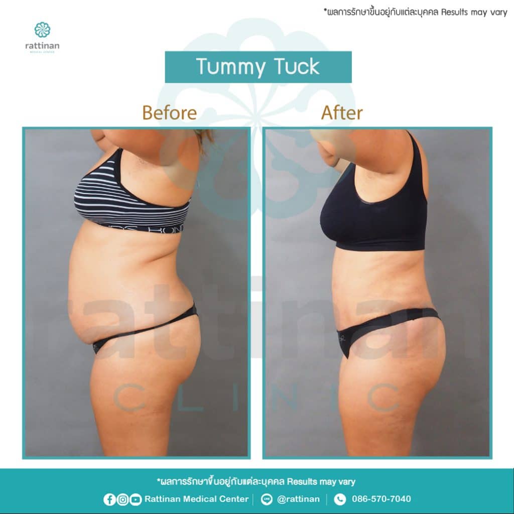 reviews tummy tuck in thailiand