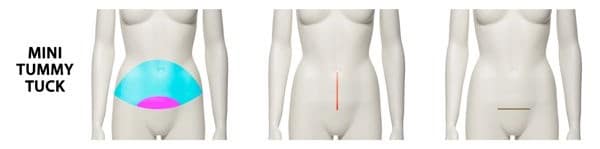 mini tummy tuck