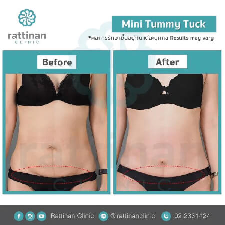 reviews mini tummy tuck in thailiand