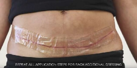 Tummy Tuck Recovery