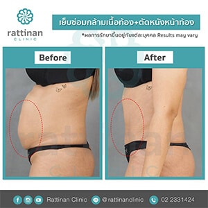 reviews tummy tuck in thailiand