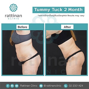 reviews tummy tuck in thailiand