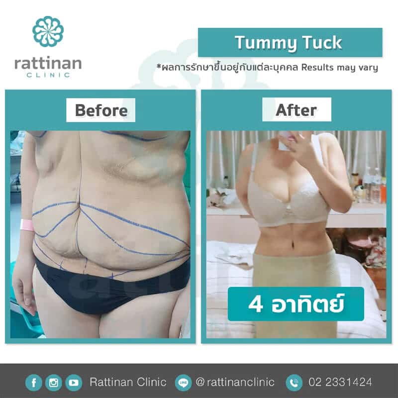 reviews tummy tuck in thailiand