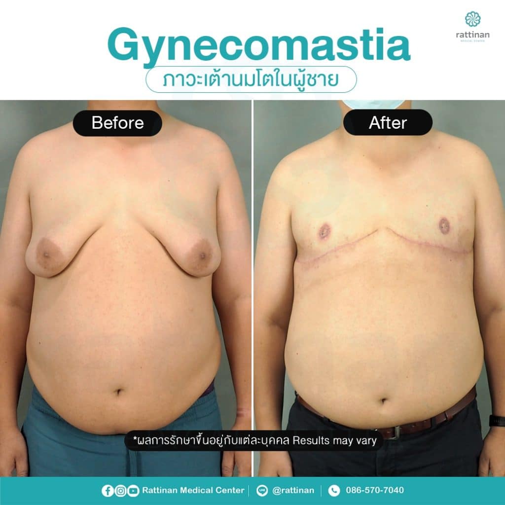 gynecomastia review - before after gynecomastia