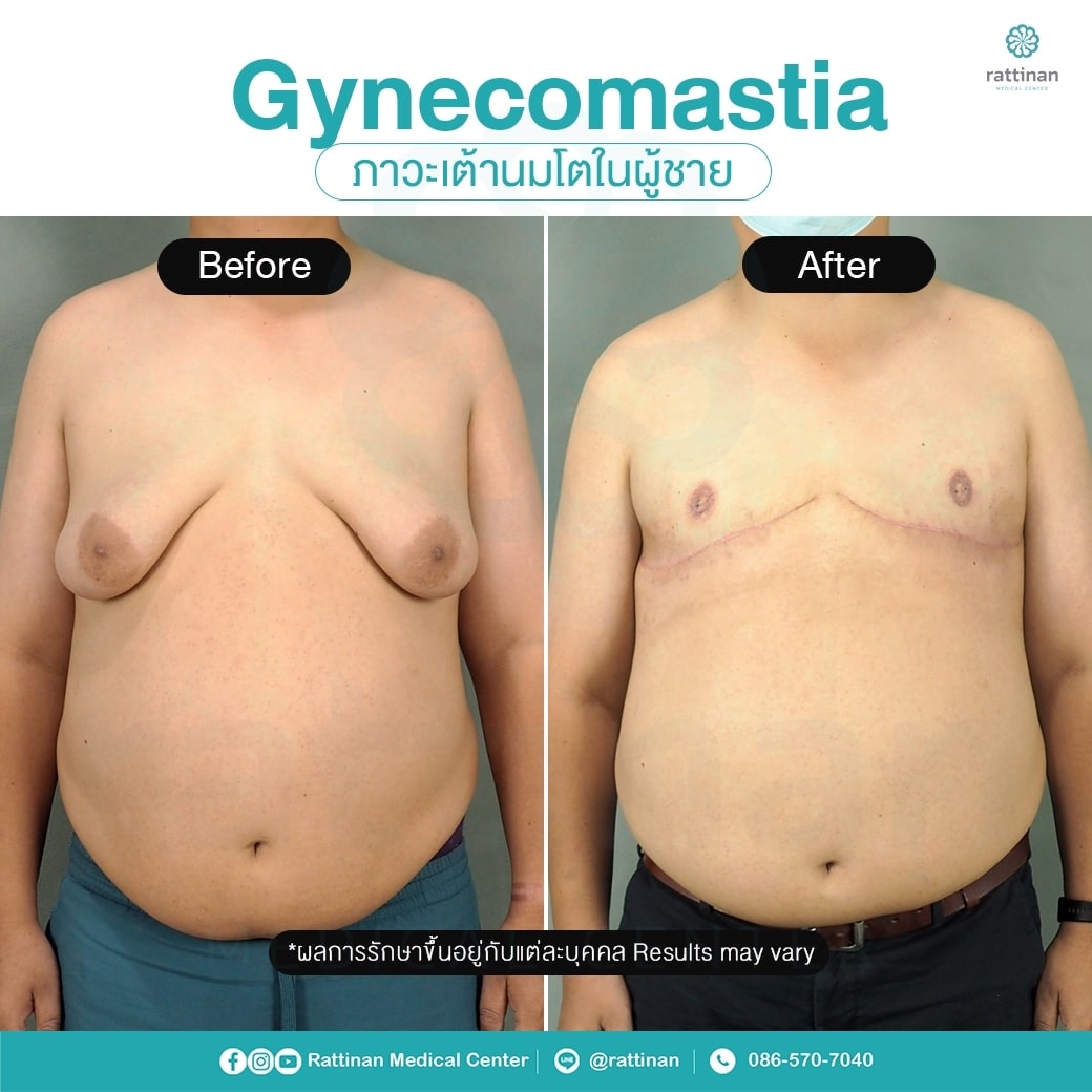 Gynecomastia Surgery in Thailand review - before after gynecomastia