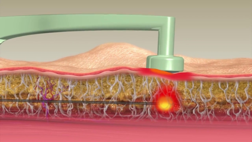 bodytite liposuction at rattinan medical center