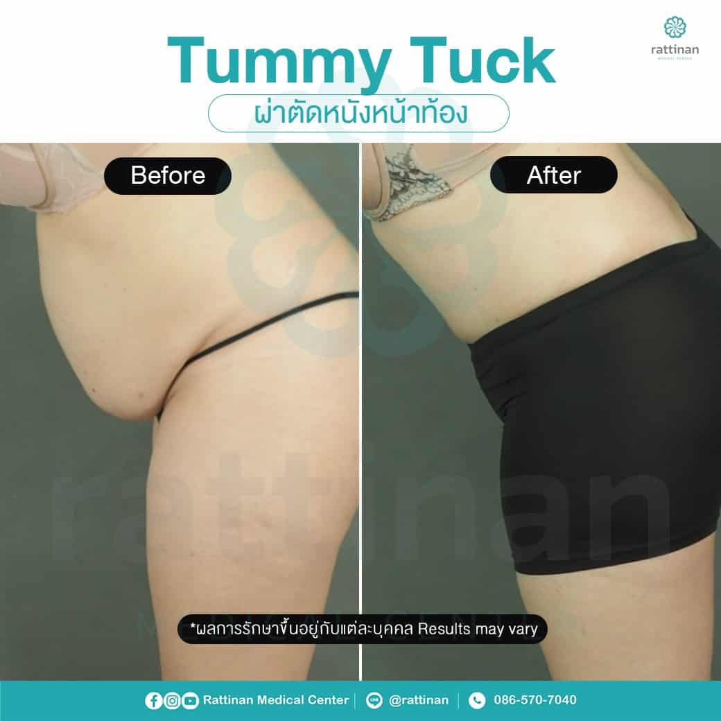 revirew tummy tuck thailand