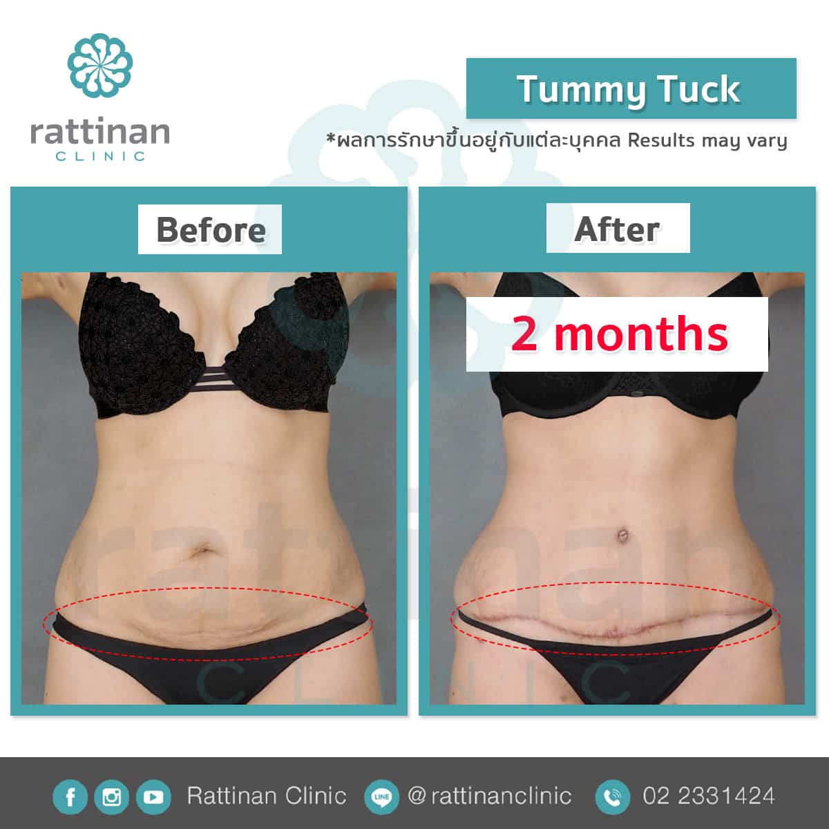 revirew tummy tuck thailand