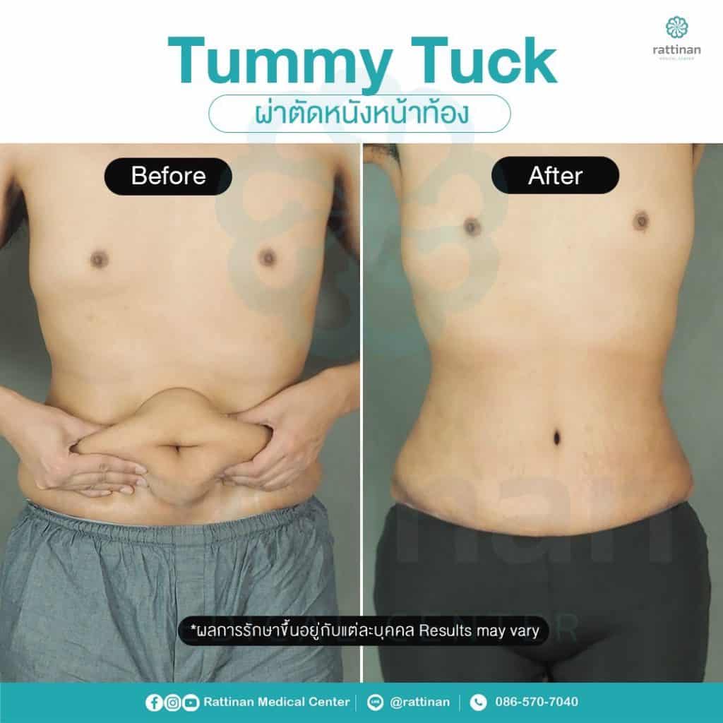 revirew tummy tuck thailand