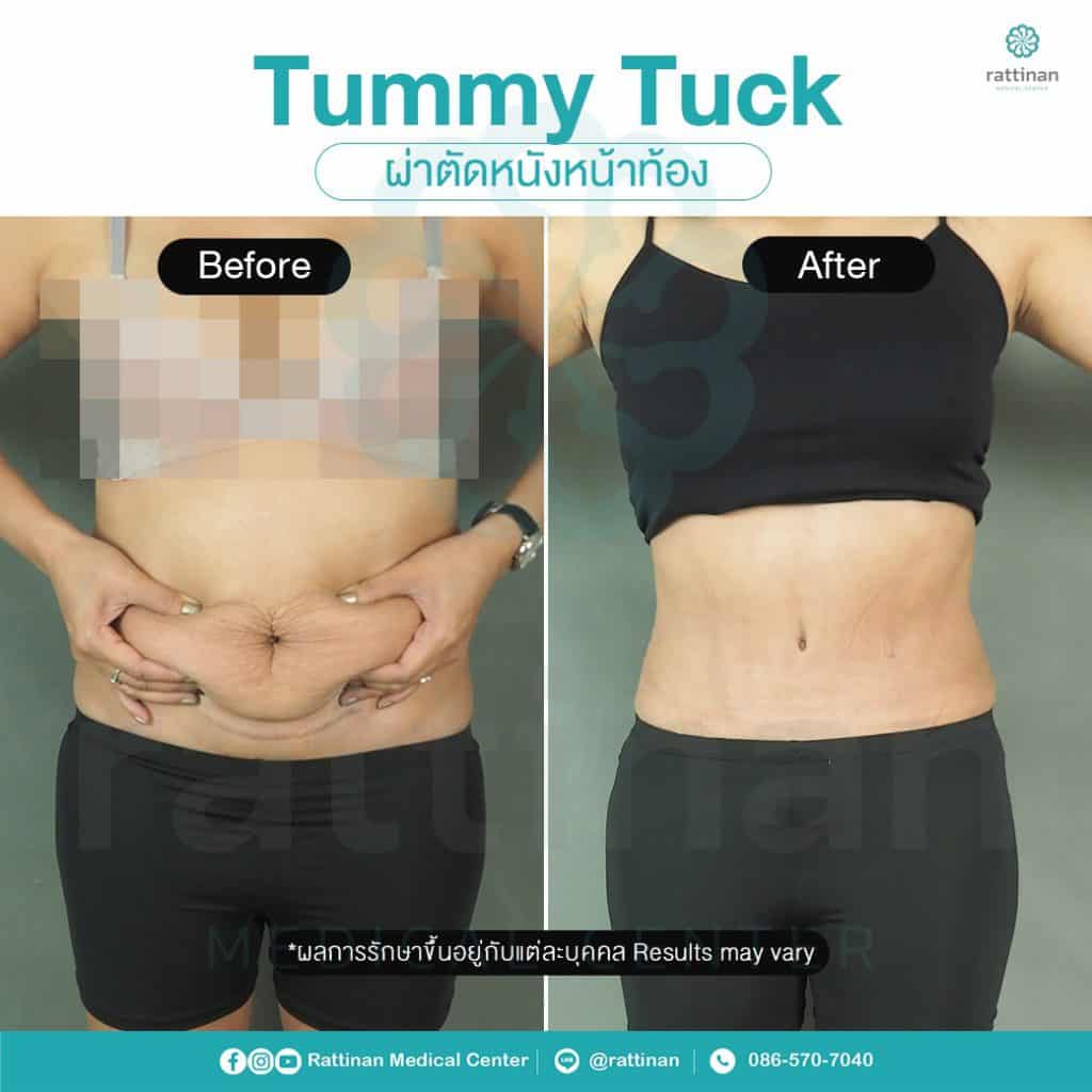 revirew tummy tuck thailand