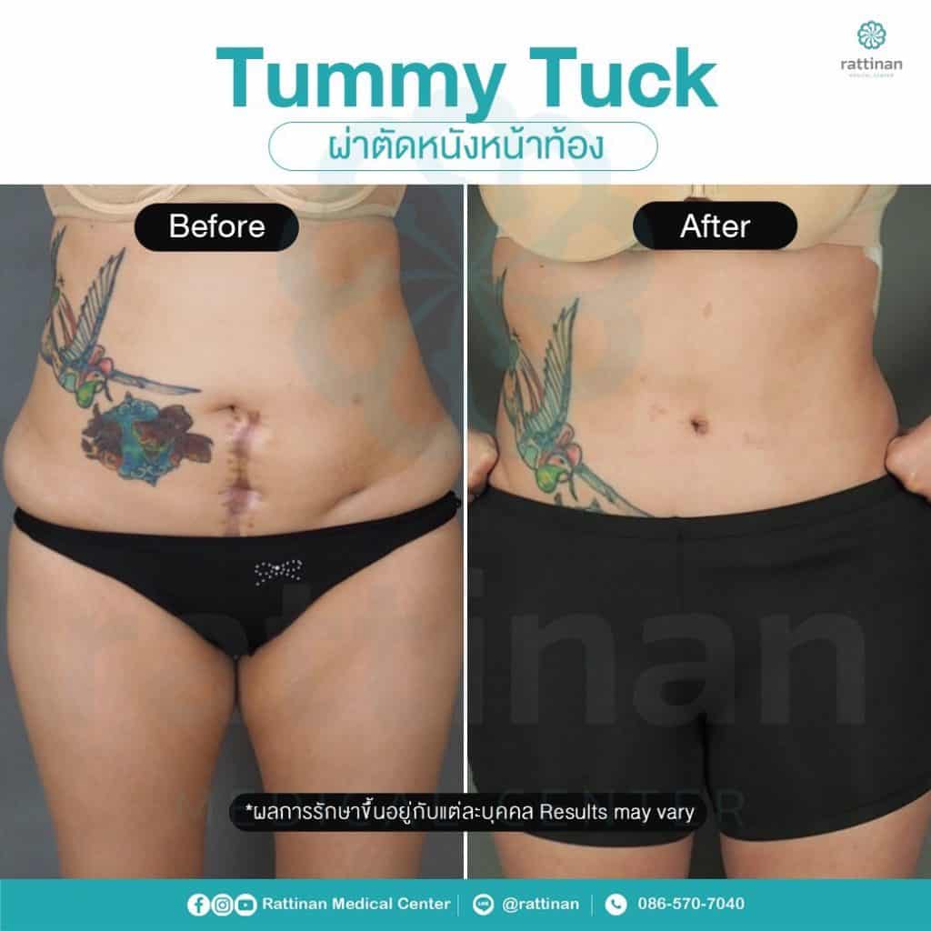 revirew tummy tuck thailand