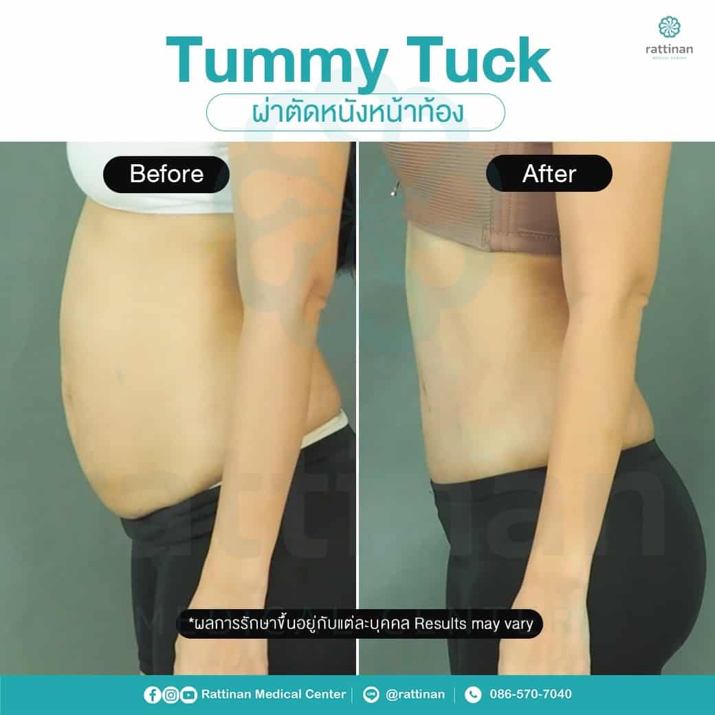 revirew tummy tuck thailand