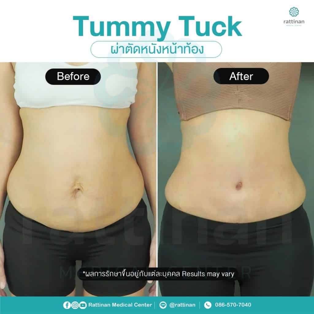 revirew tummy tuck thailand