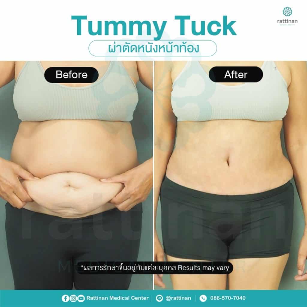 revirew tummy tuck thailand