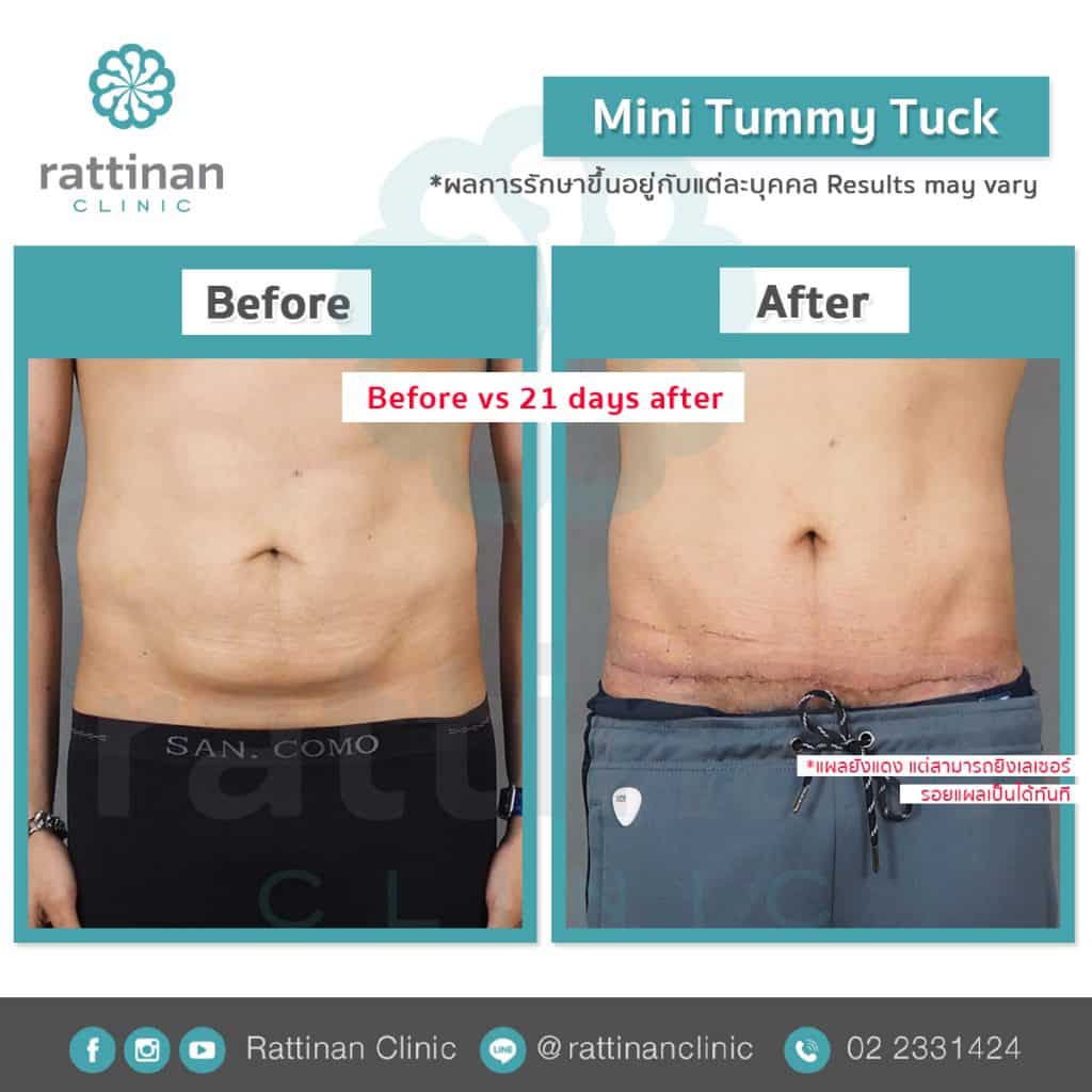 revirew tummy tuck thailand