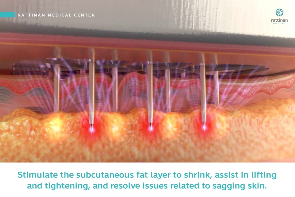 Stimulate the subcutaneous fat layer to shrink, assist in lifting and tightening, and resolve issues related to sagging skin