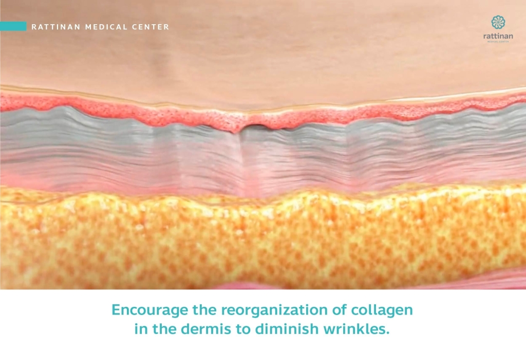 Encourage the reorganization of collagen in the dermis to diminish wrinkles