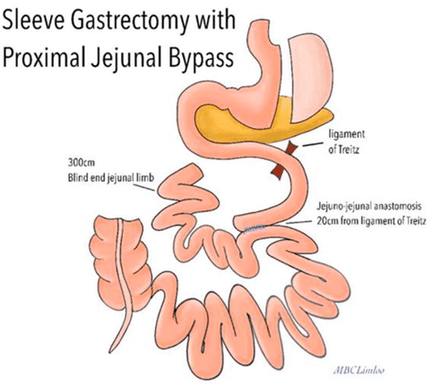 Sleeve Gastrectomy with Proximal Jejunal Bypass (SG PJB)