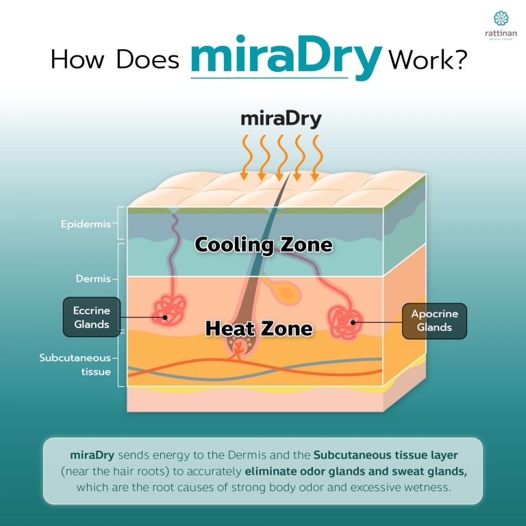 miraDry eliminates sweat body odor does not hurt does not require surgery