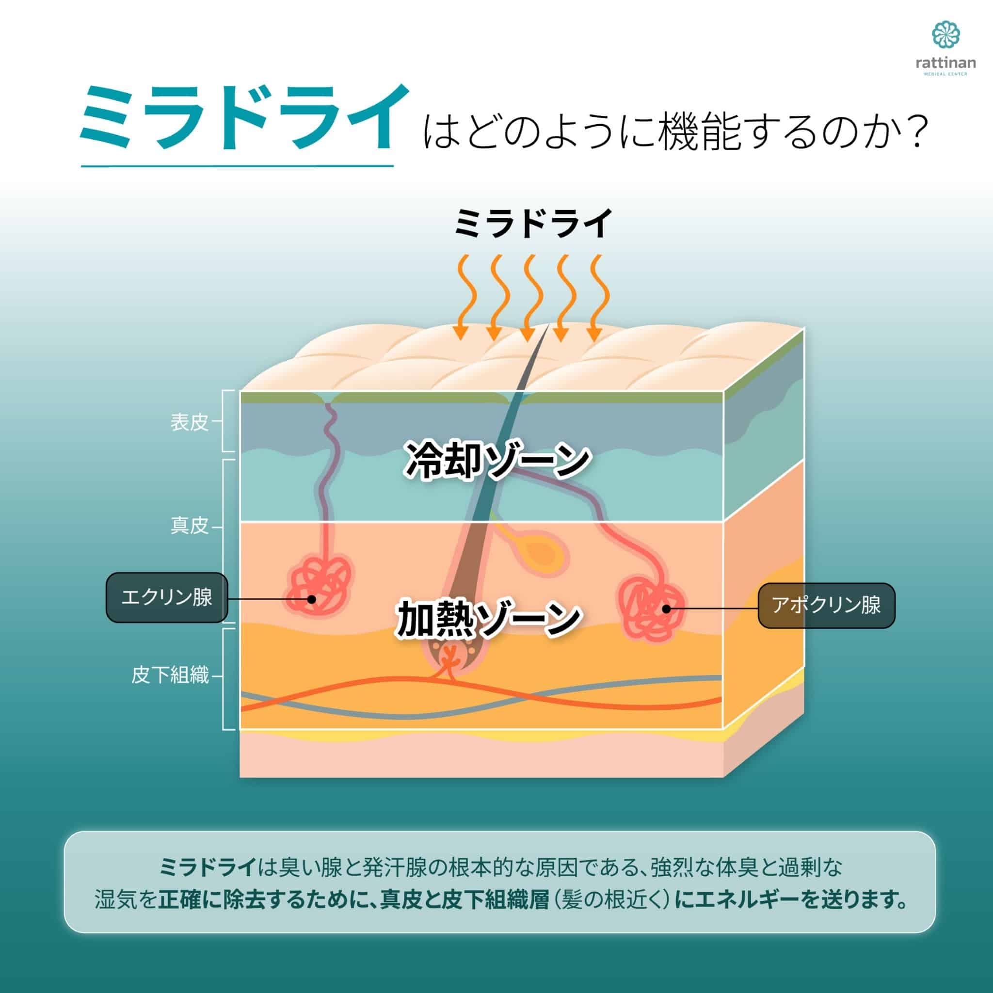 ミラドライはどのように機能するのか