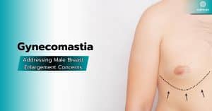 Male Breast Enlargement Concerns