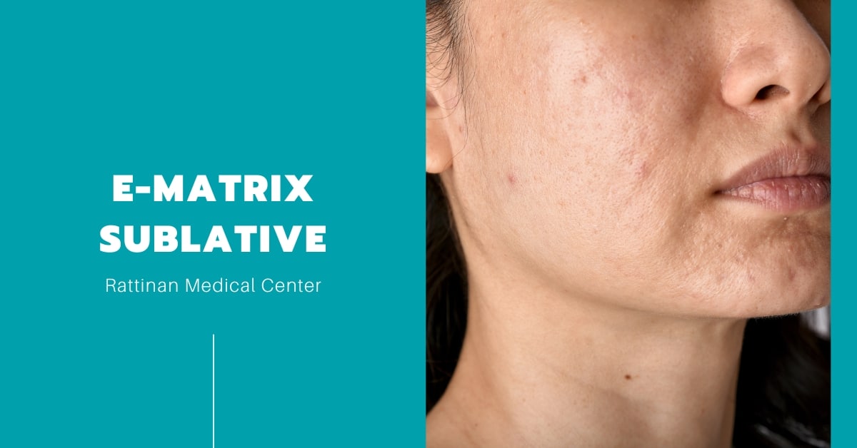 E-Matrix Sublative Skin Rejuvenation