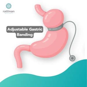 Adjustable Gastric Banding