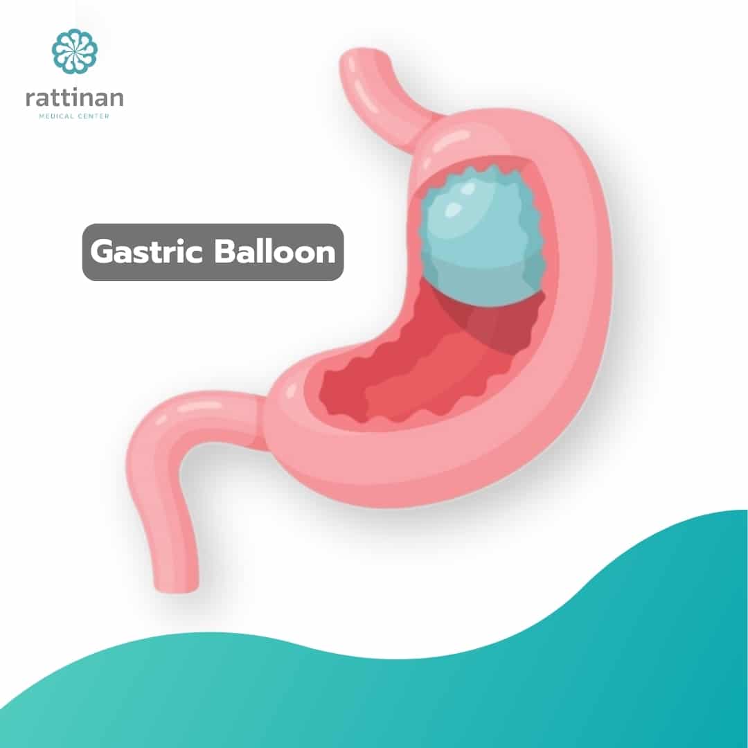 Gastric Balloon