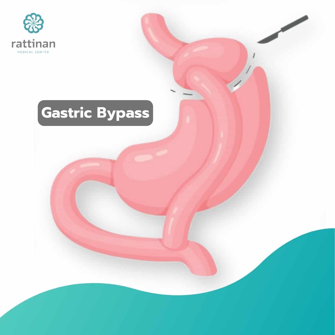 Gastric Bypass