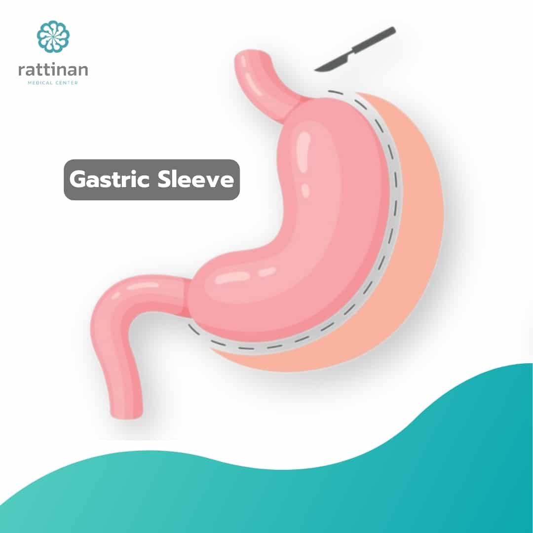 Gastric Sleeve