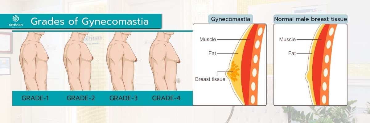 Grades of Gynecomastia