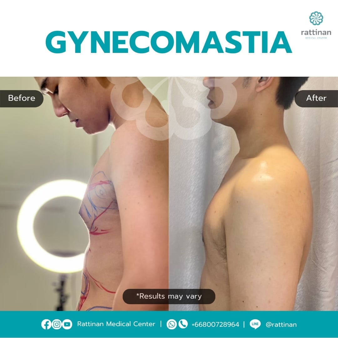 Gynecomastia Surgery in Thailand Before & After (1)
