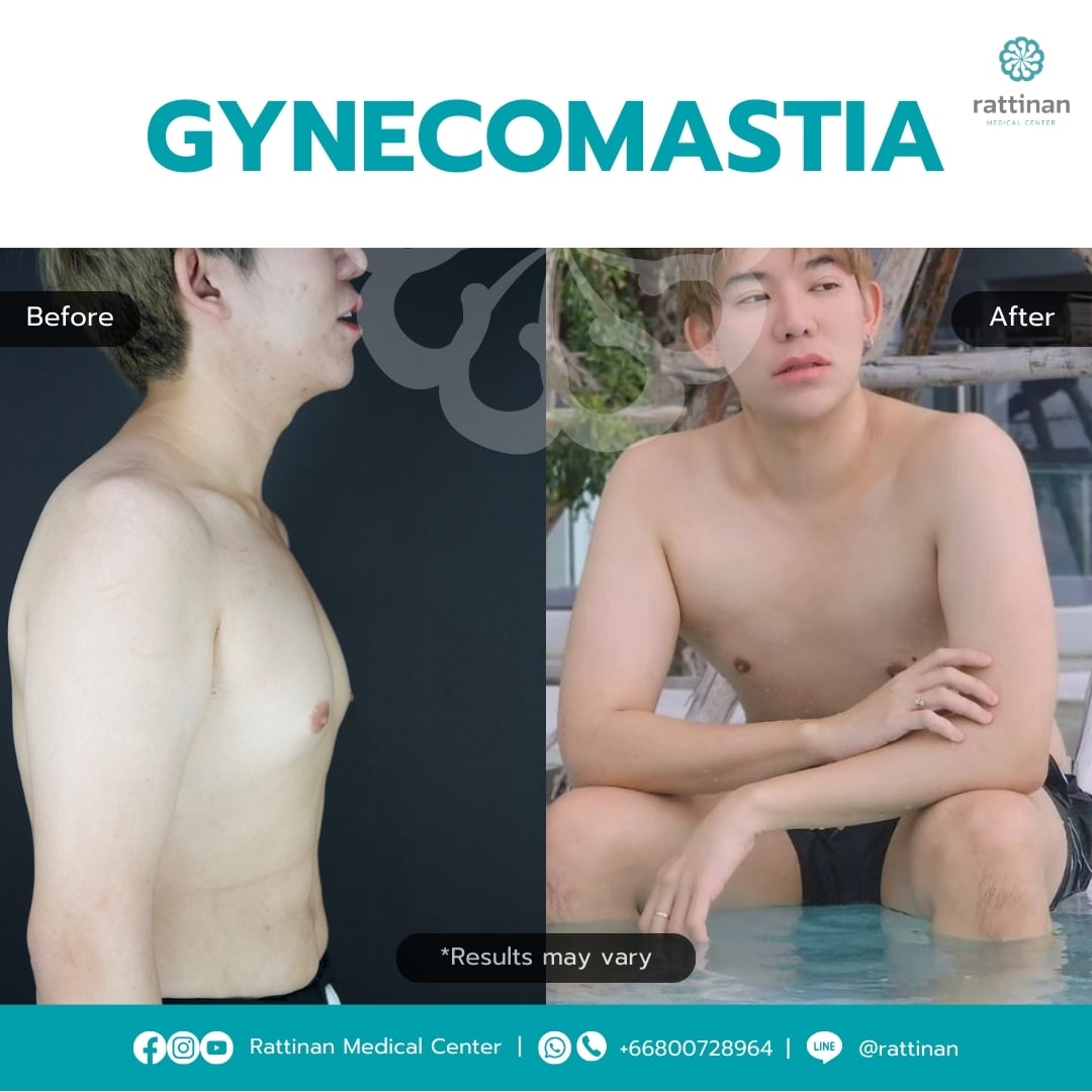 Gynecomastia Surgery in Thailand Before & After (2)